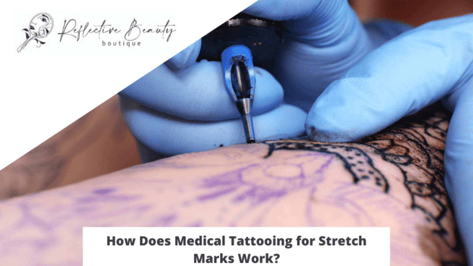 Doctors Use Tattoos to Mark the Spot for Surgery