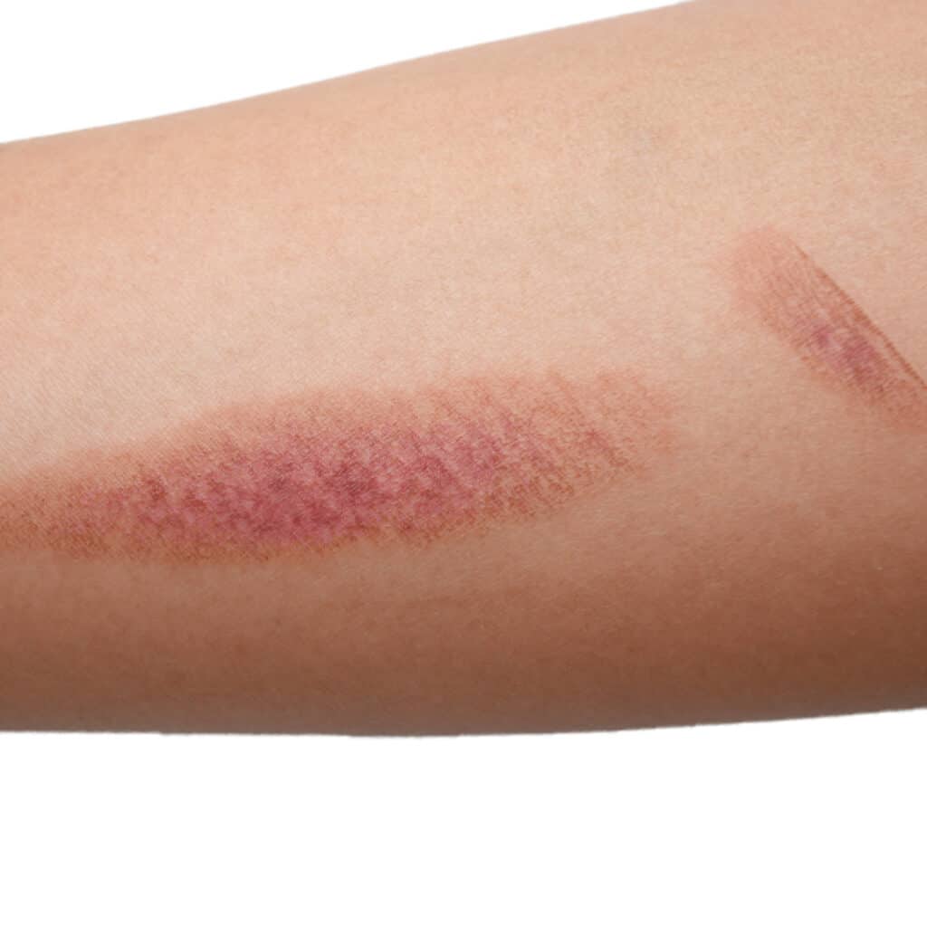 Stretch Marks: Red Vs. White. - Vancouver Permanent Makeup & Paramedical  Tattoos